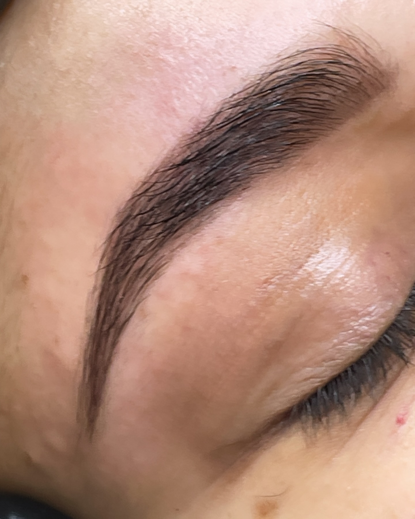 Brow lift résultat Marseille